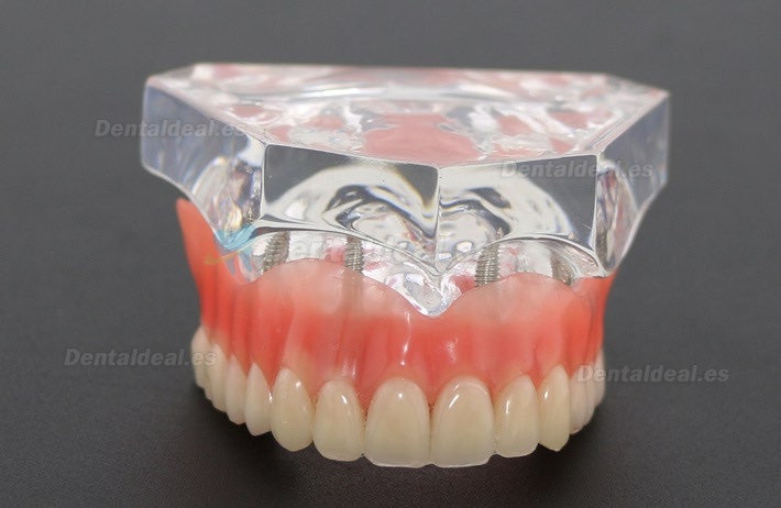 Modelo de dientes de estudio dental sobredentadura con 4 implantes modelo de demostración 6001